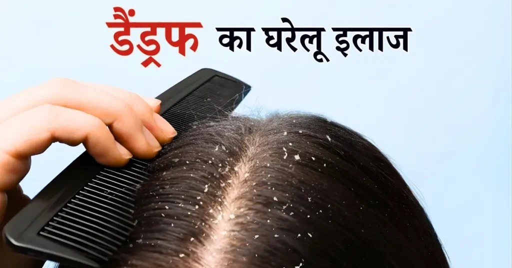 dandruff treatment at home in hindi

