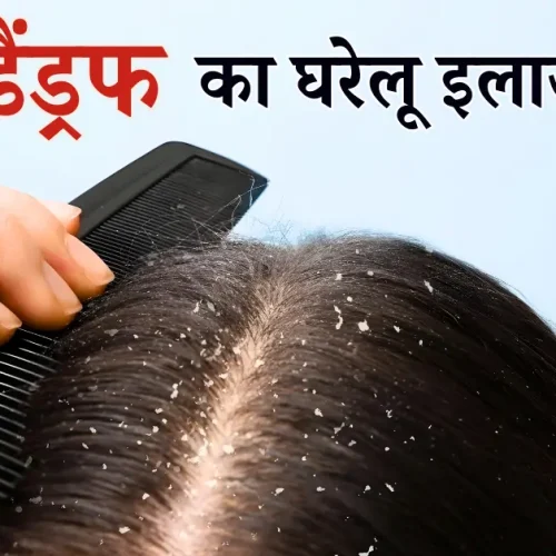 dandruff treatment at home in hindi

